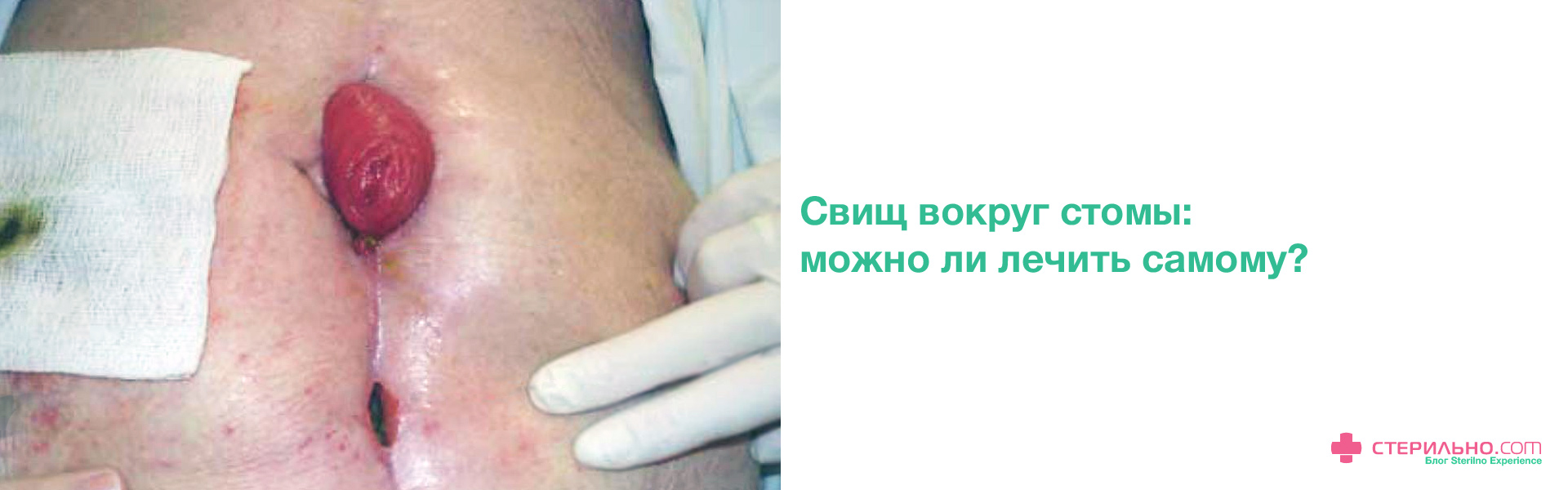 Лечение лигатурных свищей в Москве