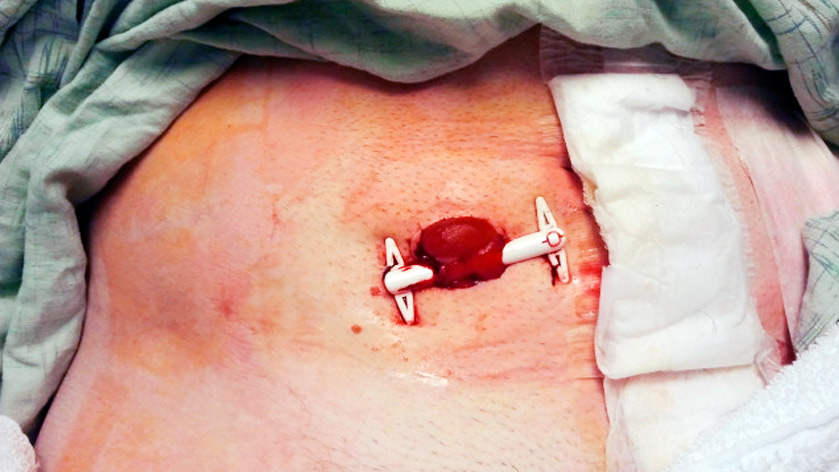 Вид стомы сразу после операции фото