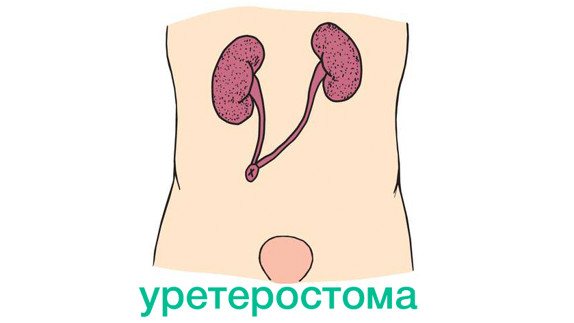 Ureterostoma
